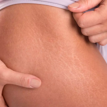 7 важных фактов о растяжках на коже
