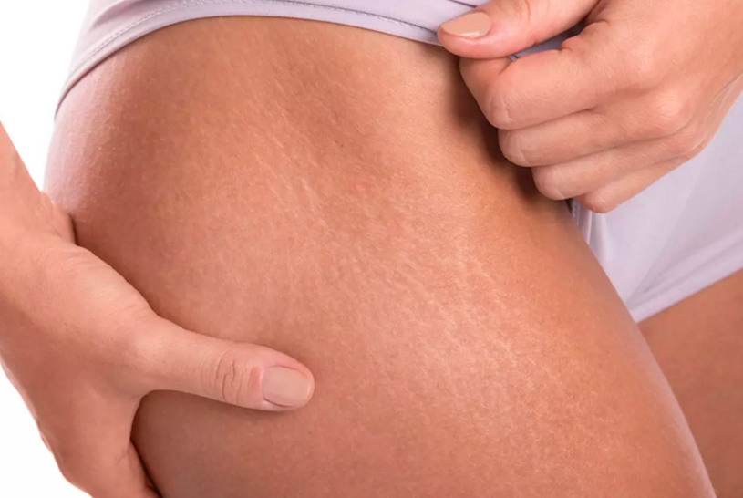 7 важных фактов о растяжках на коже