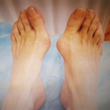 Лечение и профилактика косточек (шишек) на ногах